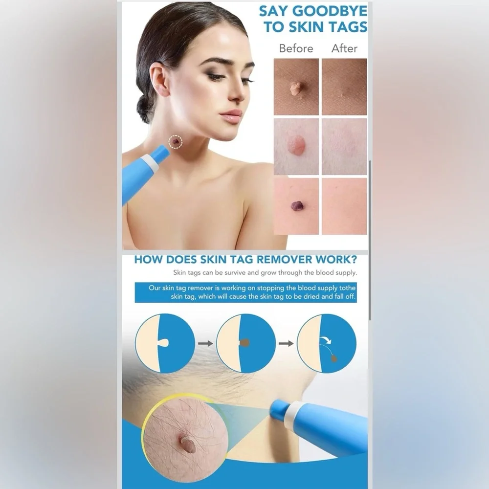 Skin Tag Remover Kit Device FDA-Cleared Safe & Effective for Home Use